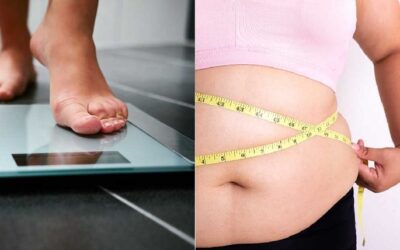 La obesidad y el sobrepeso, cómo afecta en la aparición de las várices